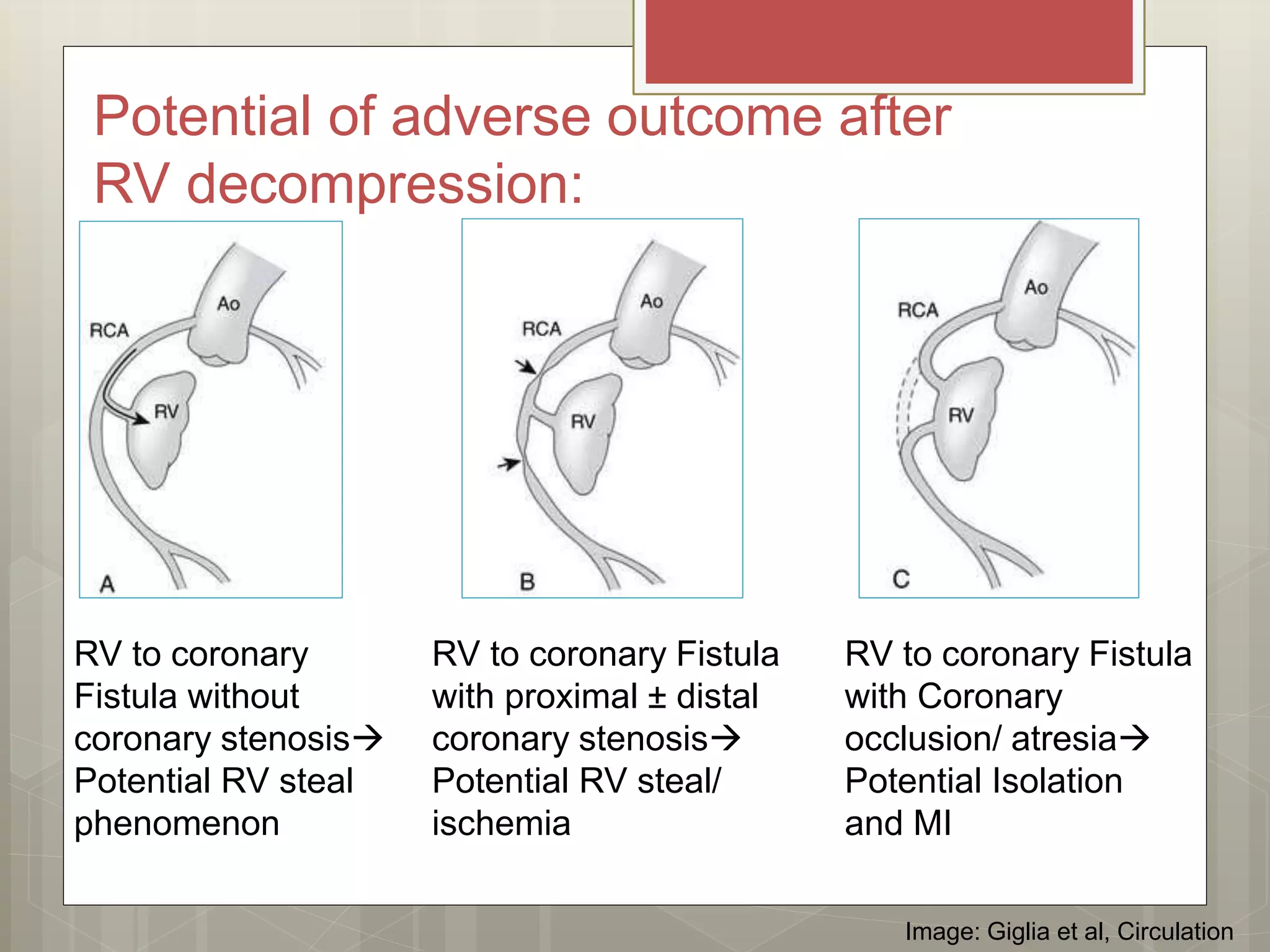 Pulmonary atresia with intact interventricular septum management | PPTX