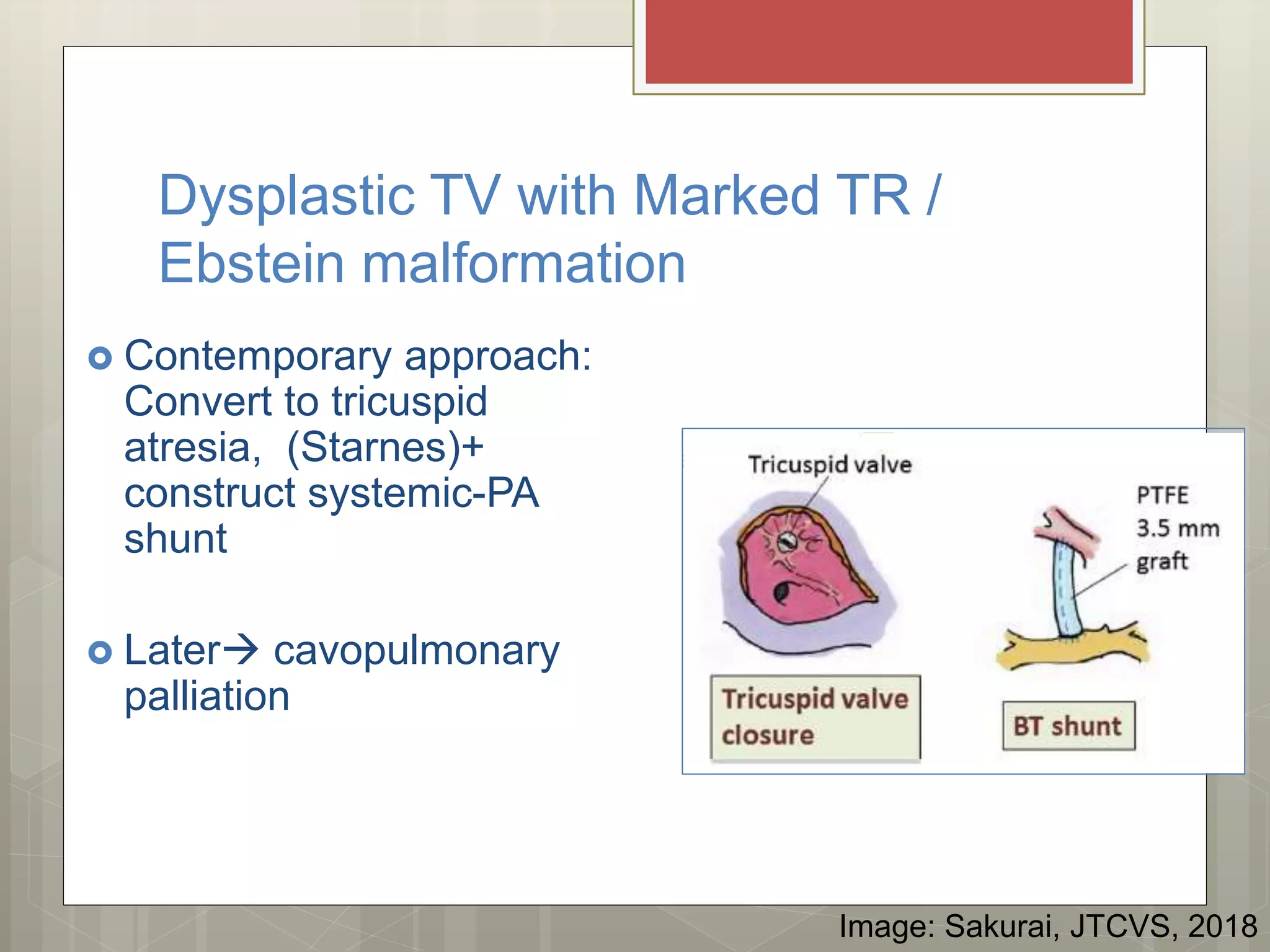 Pulmonary atresia with intact interventricular septum management | PPTX
