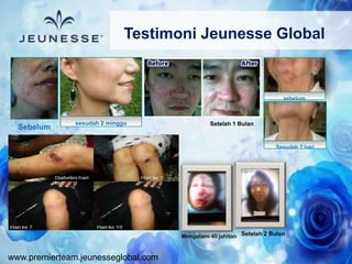 www.premierteam.jeunesseglobal.com
Testimoni Jeunesse Global
Sebelum
sesudah 2 minggu
sebelum
Sesudah 7 hari
Setelah 2 BulanMengalami 40 jahitan
Setelah 1 Bulan
 