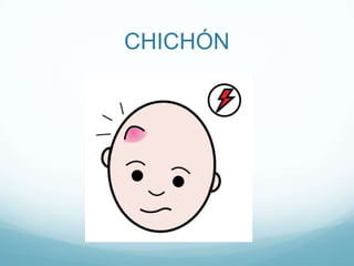 CHICHÓN
 