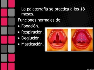 La palatorrafia se practica a los 18
  meses.
Funciones normales de:
• Fonación.
• Respiración.
• Deglución.
• Masticación.
 