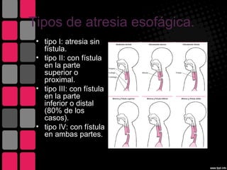 Tipos de atresia esofágica.
 • tipo I: atresia sin
   fístula.
 • tipo II: con fístula
   en la parte
   superior o
   proximal.
 • tipo III: con fístula
   en la parte
   inferior o distal
   (80% de los
   casos).
 • tipo IV: con fístula
   en ambas partes.
 