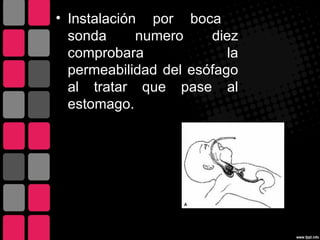 • Instalación por boca
  sonda      numero    diez
  comprobara              la
  permeabilidad del esófago
  al tratar que pase al
  estomago.
 