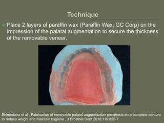  Place 2 layers of paraffin wax (Paraffin Wax; GC Corp) on the
impression of the palatal augmentation to secure the thickness
of the removable veneer.
Shimodaira et al , Fabrication of removable palatal augmentation prosthesis on a complete denture
to reduce weight and maintain hygiene , J Prosthet Dent 2018;119:855-7
 