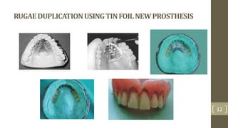 RUGAEDUPLICATIONUSINGTINFOILNEWPROSTHESIS
12
 