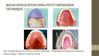 9
RUGAEDUPLICATIONUSINGPUTTYIMPRESSION
TECHNIQUE
Deo, Pratibha Katiyar Dr. Krishna, and Ritu Mohindra. "Duplication of Important Landmark-
Palatine Rugae." World 3.1 (2012): 95-96.
 