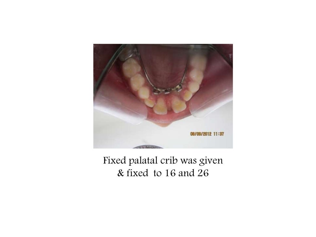 Palatal crib