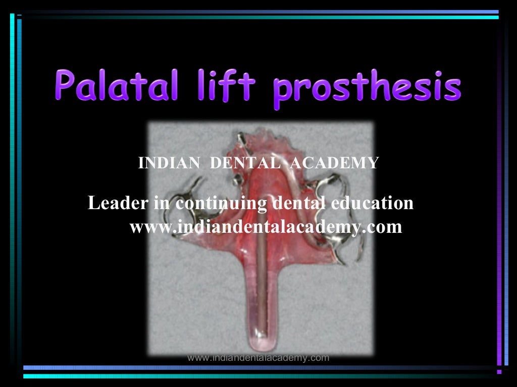 Palatal lift prosthesis/ orthodontic straight wire technique