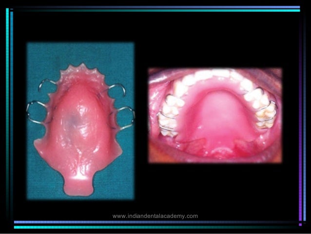 Speech bulb prosthesis Speech bulb prosthesis image
