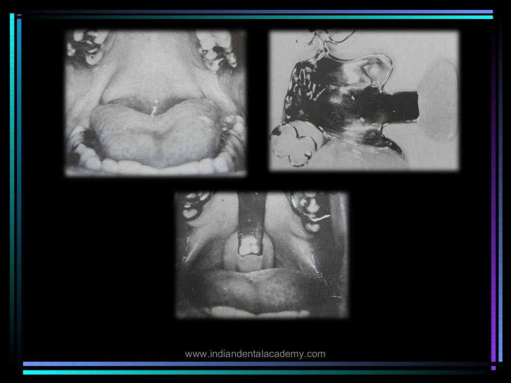 Palatal lift prosthesis/ orthodontic straight wire technique