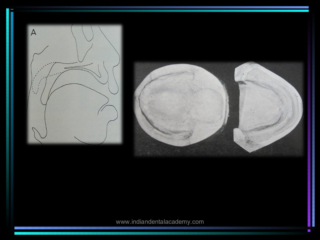 Palatal lift prosthesis/ orthodontic straight wire technique