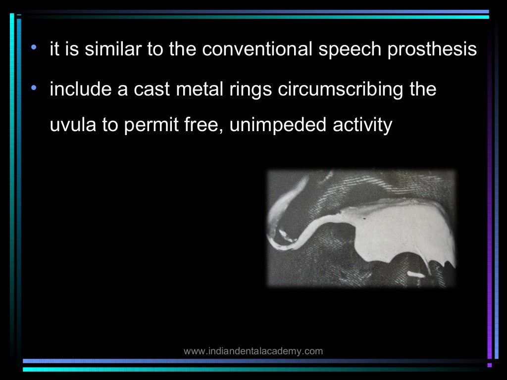 Palatal lift prosthesis/ orthodontic straight wire technique