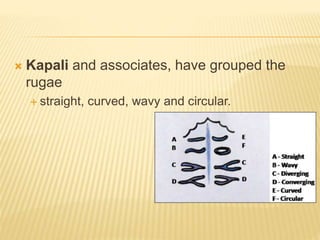 Nasopalatal Ruggae Palatal rugae | PPTX
