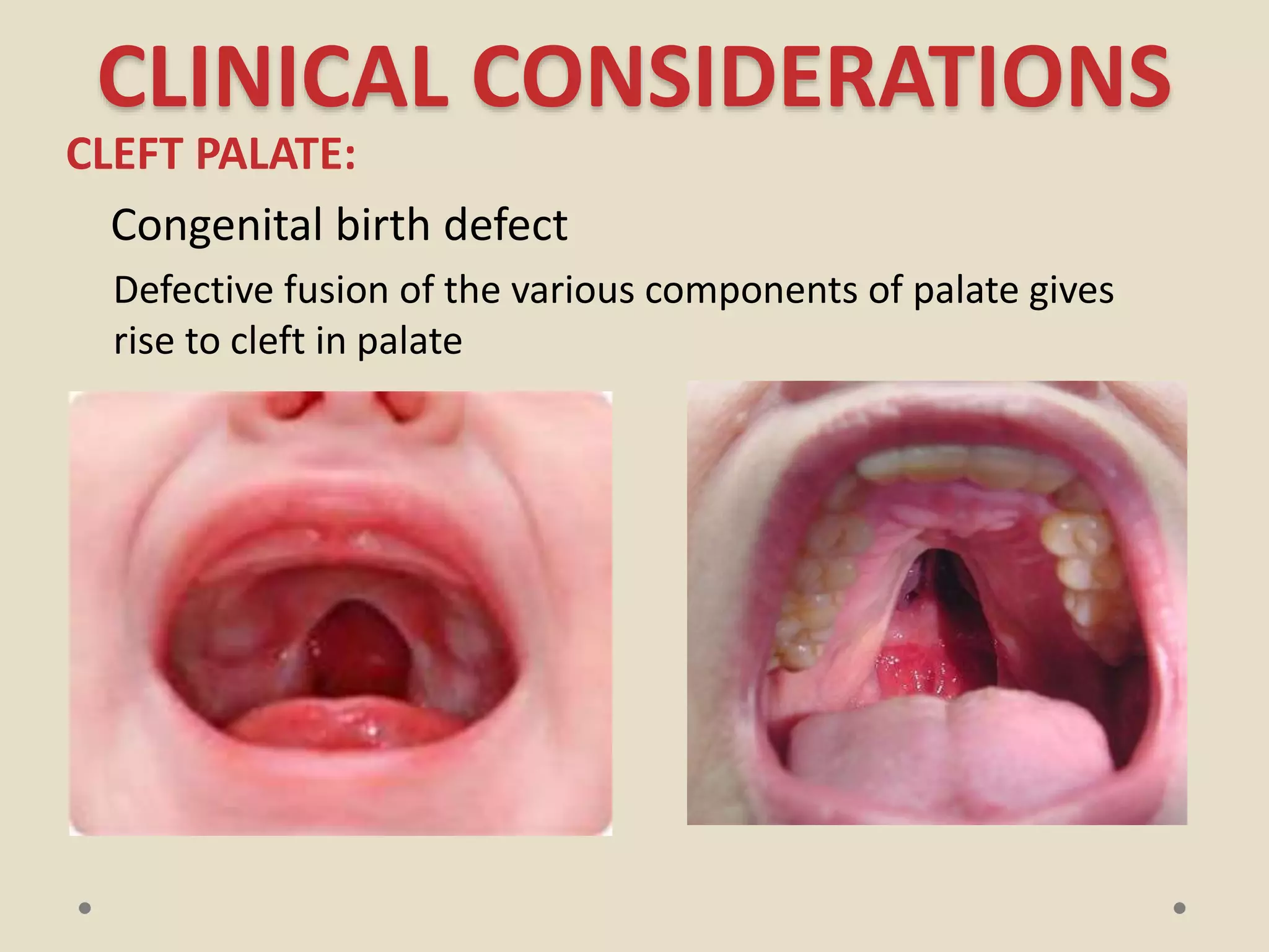 Palate PPT | PPTX