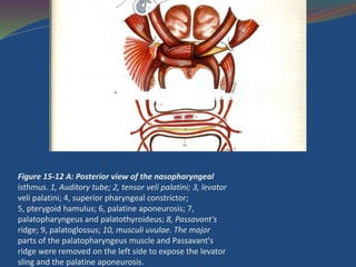 Figure 15-12 A: Posterior view of the nasopharyngeal
isthmus. 1, Auditory tube; 2, tensor veli palatini; 3, levator
veli palatini; 4, superior pharyngeal constrictor;
5, pterygoid hamulus; 6, palatine aponeurosis; 7,
palatopharyngeus and palatothyroideus; 8, Passavant's
ridge; 9, palatoglossus; 10, musculi uvulae. The major
parts of the palatopharyngeus muscle and Passavant's
ridge were removed on the left side to expose the levator
sling and the palatine aponeurosis.
 