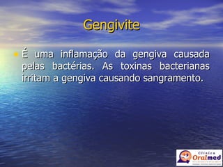Gengivite É uma inflamação da gengiva causada pelas bactérias. As toxinas bacterianas irritam a gengiva causando sangramento. 