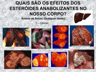 QUAIS SÃO OS EFEITOS DOS ESTERÓIDES ANABOLIZANTES NO NOSSO CORPO?Ambos os Sexos (Qualquer Idade):1 – Câncer;
