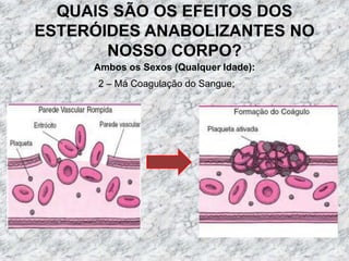 QUAIS SÃO OS EFEITOS DOS ESTERÓIDES ANABOLIZANTES NO NOSSO CORPO?Ambos os Sexos (Qualquer Idade):2 – Má Coagulação do Sangue;