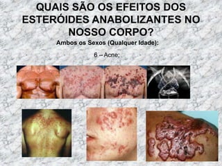 QUAIS SÃO OS EFEITOS DOS ESTERÓIDES ANABOLIZANTES NO NOSSO CORPO?Ambos os Sexos (Qualquer Idade):6 – Acne;