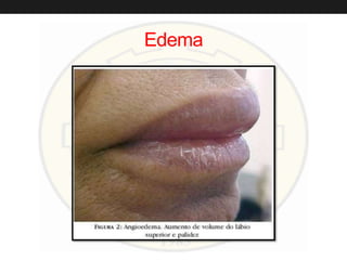 Edema
 
