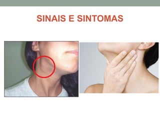 SINAIS E SINTOMAS
 