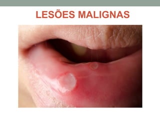 LESÕES MALIGNAS
 