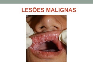 LESÕES MALIGNAS
 