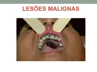 LESÕES MALIGNAS
 