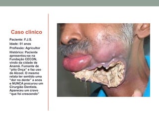 Caso clinico
Paciente: F.J.S.
Idade: 51 anos
Profissão: Agricultor
Histórico: Paciente
apresentou-se na
Fundação CECON,
vindo da cidade de
Anamã. Fumante de
“pito Onça” e faz uso
de Alcool. O mesmo
relata ter sentido uma
“dor no dente” a anos
e NUNCA procurou um
Cirurgião Dentista.
Apareceu um cravo
“que foi crescendo”
 