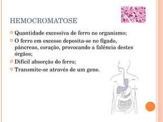HEMOCROMATOSE Quantidade excessiva de ferro no organismo; O ferro em excesso deposita-se no fígado, pâncreas, coração, provocando a falência destes órgãos; Difícil absorção do ferro; Transmite-se através de um gene. 