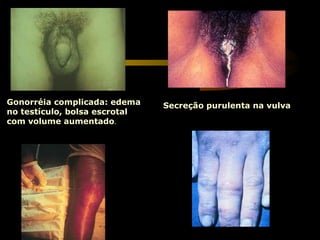 Gonorréia complicada: edema
no testículo, bolsa escrotal
com volume aumentado.
Secreção purulenta na vulva
 
