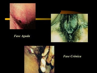 Fase Aguda
Fase Crônica
 