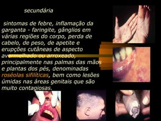 secundária
sintomas de febre, inflamação da
garganta - faringite, gânglios em
várias regiões do corpo, perda de
cabelo, de peso, de apetite e
erupções cutâneas de aspecto
avermelhado ou arroxeado,
principalmente nas palmas das mãos
e plantas dos pés, denominadas
roséolas sifilíticas, bem como lesões
úmidas nas áreas genitais que são
muito contagiosas.
 