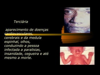 Terciária
aparecimento de doenças
cardiovasculares,
cerebrais e da medula
espinhal, olhos,
conduzindo a pessoa
infectada a paralisias,
insanidade, cegueira e até
mesmo a morte.
 