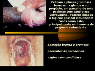 Eritema e placas grumosas
brancas na glande e no
prepúcio, em parceiro de uma
paciente com candidíase
vulvovaginal. Fatores ligados
à higiene pessoal influenciam
casos como este,
principalmente em homens de
prepúcio redundante.
Secreção branca e grumosa
aderentes às paredes da
vagina com candidíase.
 
