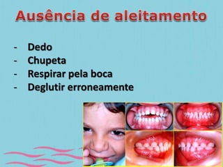 - Dedo 
- Chupeta 
- Respirar pela boca 
- Deglutir erroneamente 
 