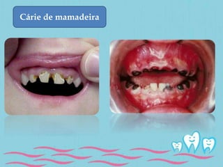 Cárie de mamadeira 
 