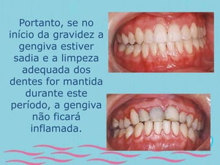 Portanto, se no 
início da gravidez a 
gengiva estiver 
sadia e a limpeza 
adequada dos 
dentes for mantida 
durante este 
período, a gengiva 
não ficará 
inflamada. 
 