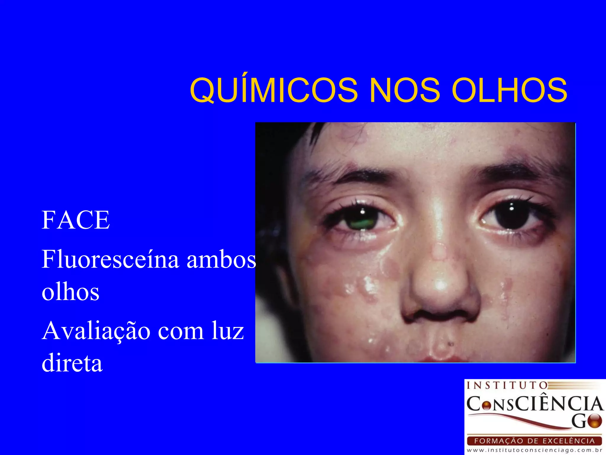 QUÍMICOS NOS OLHOS FACE Fluoresceína ambos olhos Avaliação com luz direta 