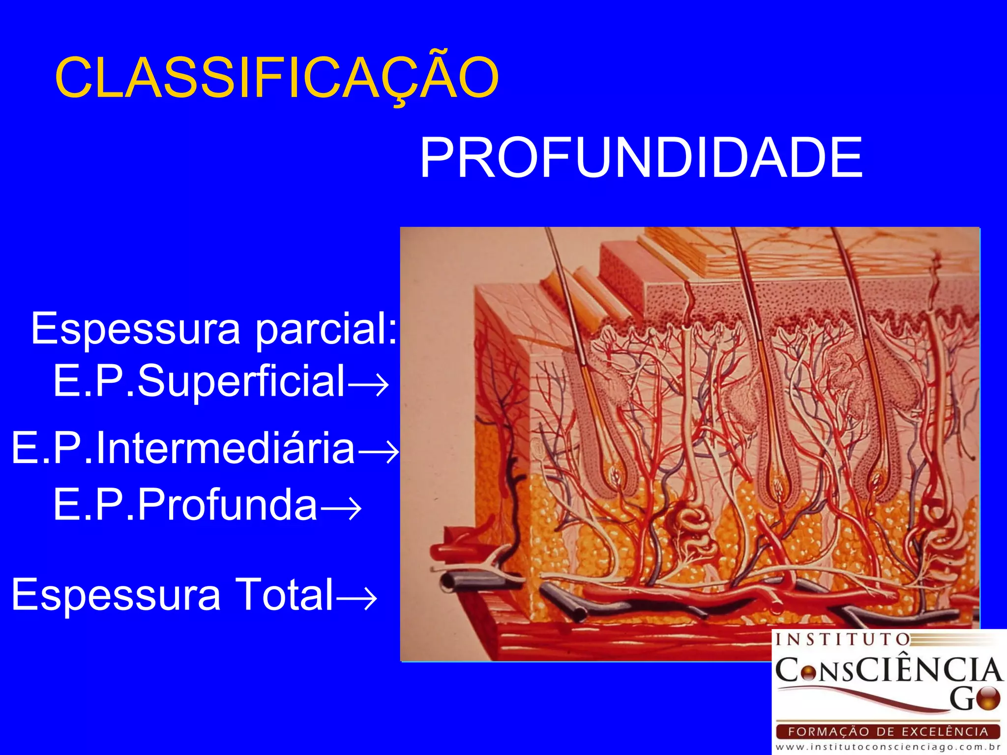 PROFUNDIDADE CLASSIFICAÇÃO Espessura parcial: E.P.Superficial  E.P.Intermediária  E.P.Profunda  Espessura Total  