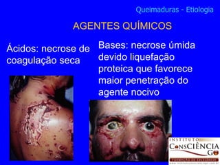 Bases: necrose úmida devido liquefação proteica que favorece maior penetração do agente nocivo Queimaduras - Etiologia AGENTES QUÍMICOS Ácidos: necrose de coagulação seca 