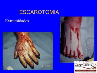 ESCAROTOMIA Extremidades 