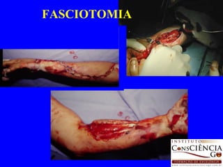 FASCIOTOMIA 