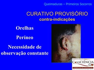 Orelhas Períneo Necessidade de observação constante CURATIVO PROVISÓRIO contra-indicações Queimaduras – Primeiros Socorros 