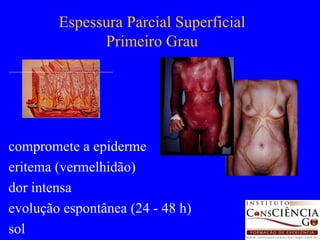Espessura Parcial Superficial Primeiro Grau compromete a epiderme eritema (vermelhidão) dor intensa evolução espontânea (24 - 48 h) sol 
