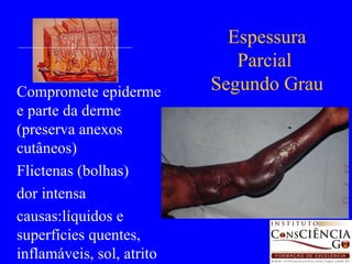 Compromete epiderme e parte da derme (preserva anexos cutâneos) Flictenas (bolhas) dor intensa causas:líquidos e superfícies quentes, inflamáveis, sol, atrito Espessura Parcial  Segundo Grau 