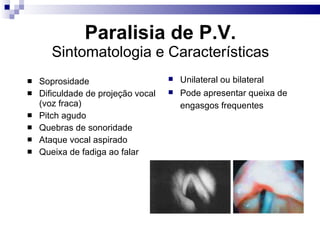 Paralisia de P.V.
Sintomatologia e Características
 Soprosidade
 Dificuldade de projeção vocal
(voz fraca)
 Pitch agudo
 Quebras de sonoridade
 Ataque vocal aspirado
 Queixa de fadiga ao falar
 Unilateral ou bilateral
 Pode apresentar queixa de
engasgos frequentes
 
