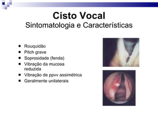 Cisto Vocal Sintomatologia e Características Rouquidão Pitch grave Soprosidade (fenda) Vibração da mucosa reduzida Vibração de ppvv assimétrica Geralmente unilaterais 