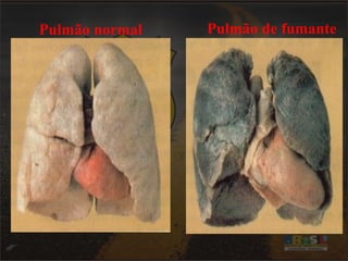 Pulmão normal Pulmão de fumante 
 
