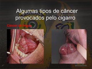 Algumas tipos de câncer 
provocados pelo cigarro 
Câncer de língua 
 
